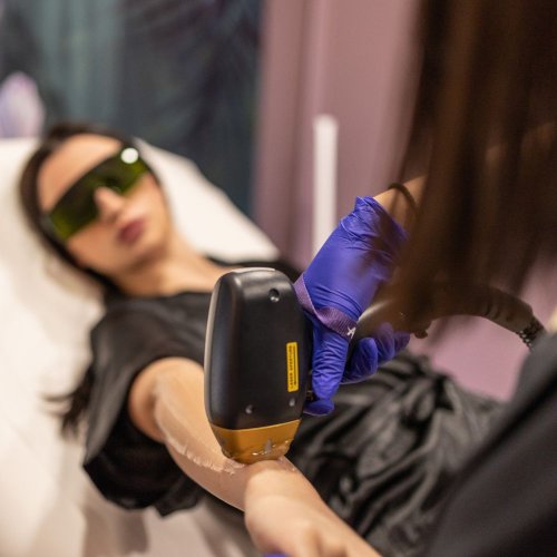 LASER αποτρίχωση χέρια 3+1 συνεδρίες