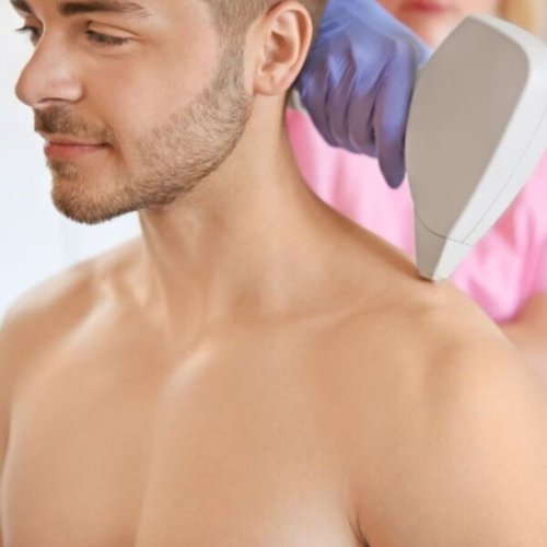 LASER αποτρίχωση ώμοι 3+1 συνεδρίες