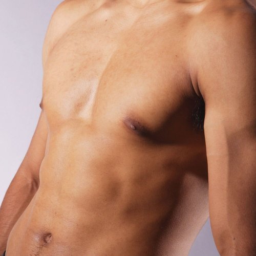 Laser αποτρίχωση κορμός 3+1 συνεδρίες