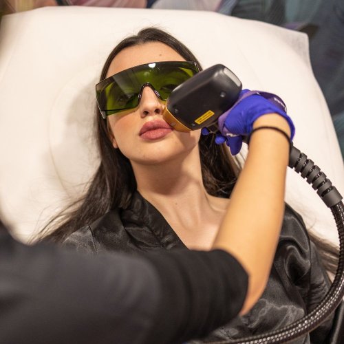 LASER αποτρίχωση άνω χείλος 3+1 συνεδρίες