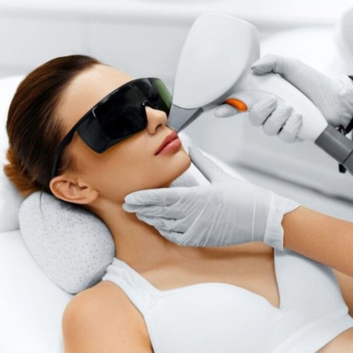 Laser αποτρίχωση πρόσωπο 3 +1 συνεδρίες